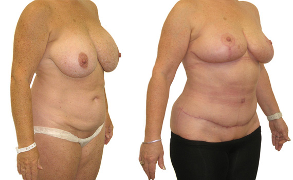 before and after photograph mummy makeover performed by consultant plastic surgeon Hassan Shaaban